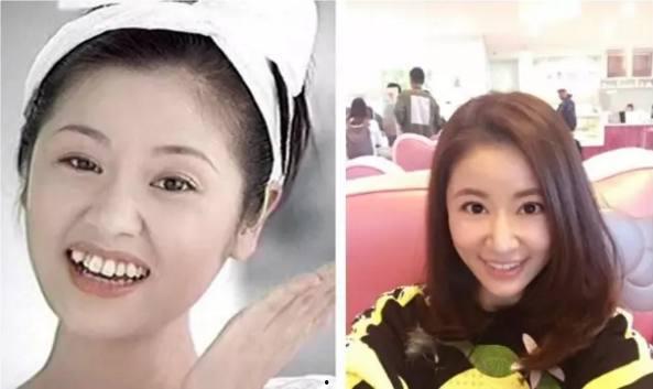 整牙的明星网红,揭秘整牙秘籍